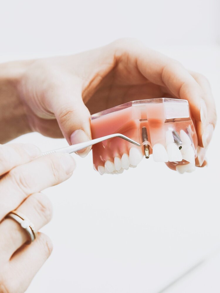 Dental implants