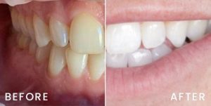 san-francisco-invisalign-01