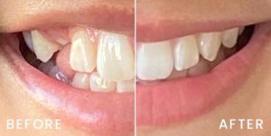 san-francisco-invisalign-02