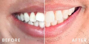 san-francisco-invisalign-03