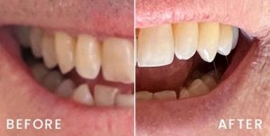san-francisco-invisalign-04