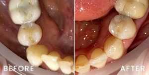 san-francisco-invisalign-05