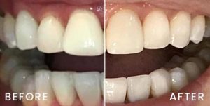 san-francisco-invisalign-06