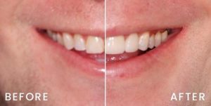 san-francisco-veneers-01