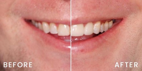 san-francisco-veneers-01