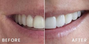 san-francisco-veneers-02