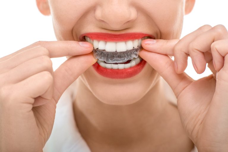 Wearing Invisalign