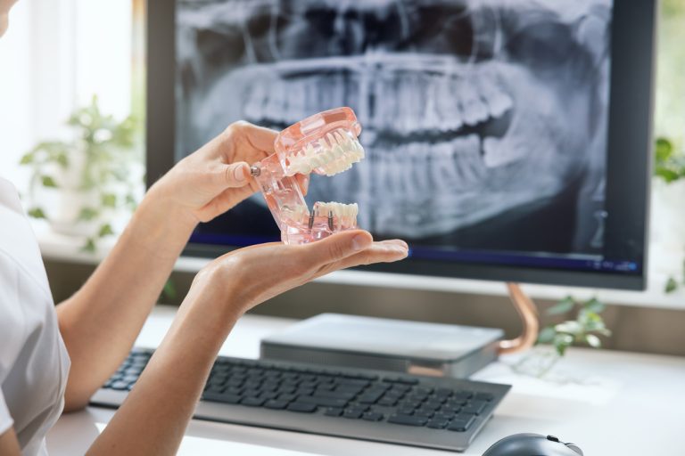 Dental Implants
