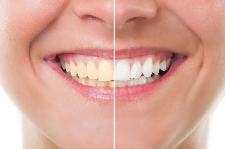 does teeth whitening hurt