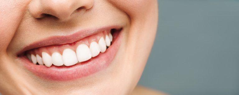 Close-up of a bright smile with smooth pink gums visible above the upper teeth—an example of what is a gummy smile, where extra gum shows when someone smiles.