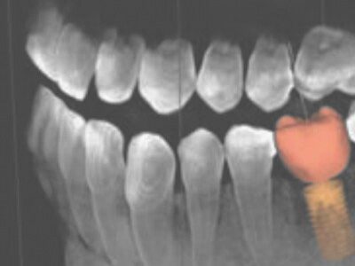 3d-imaging Example of 3D imaging at Sunset Dentistry