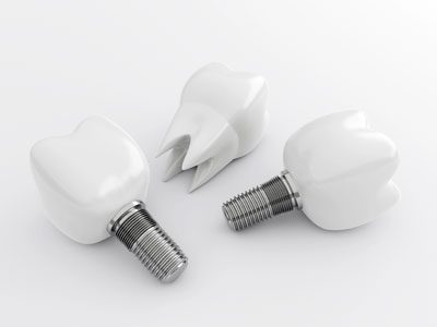 implants-SFSunset Examples of tooth implants on white background